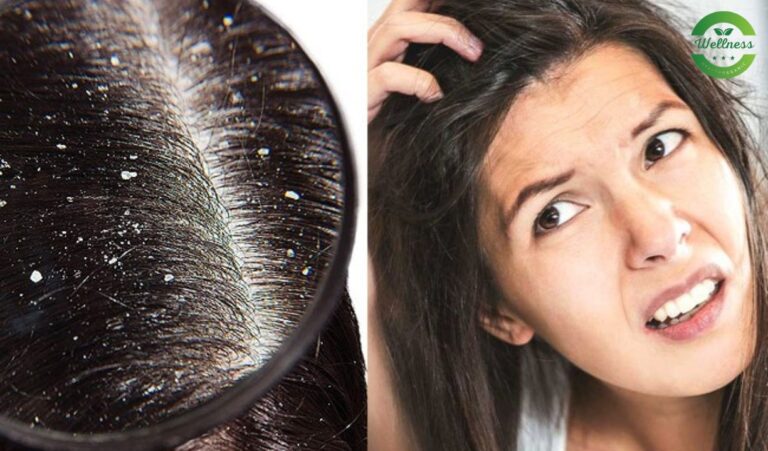 Dandruff Remedies